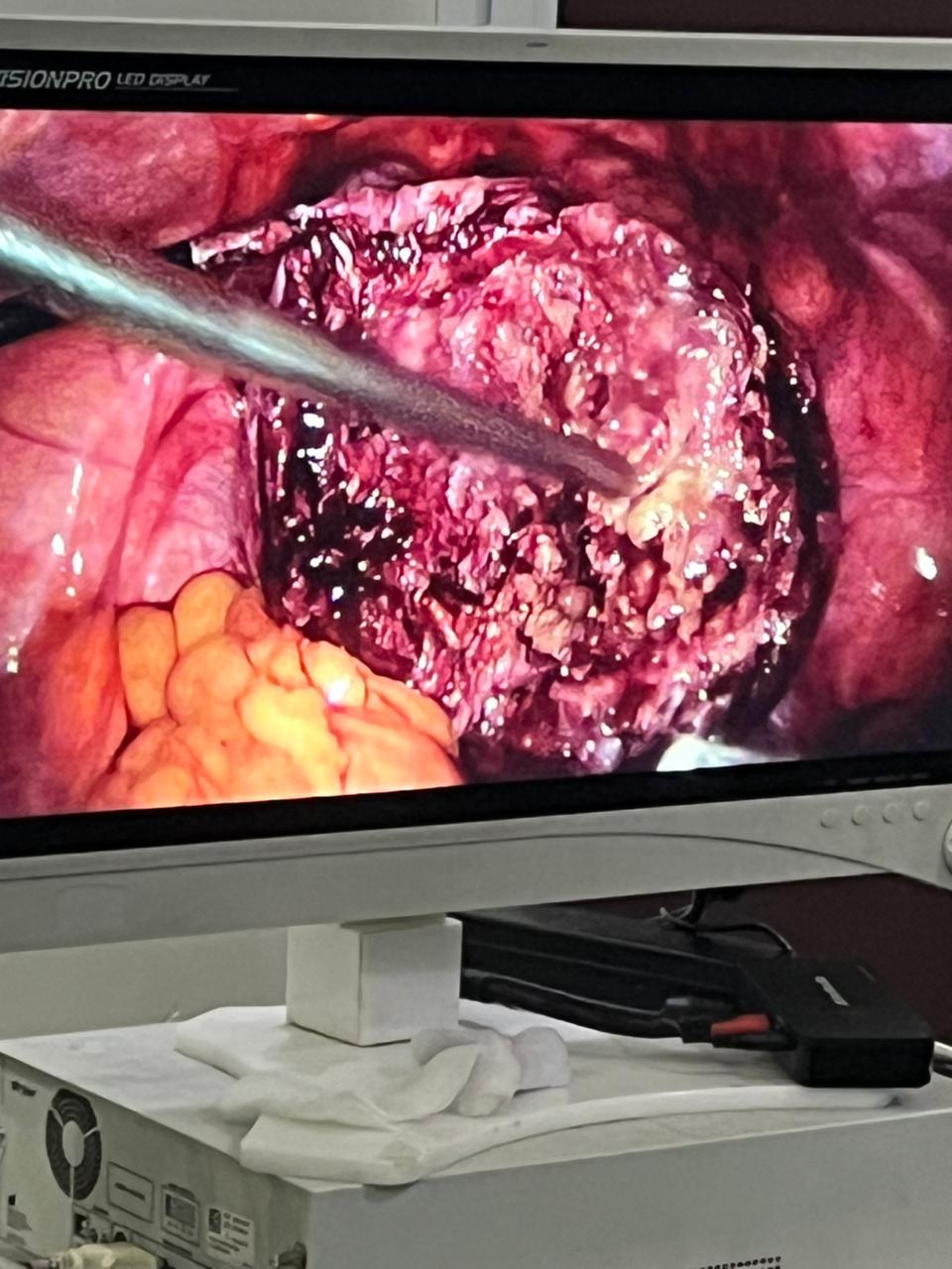 Successful Removal of Large Uterine Fibroid (10 cm) Laparoscopically by Dr. Deepshikha Dwivedi